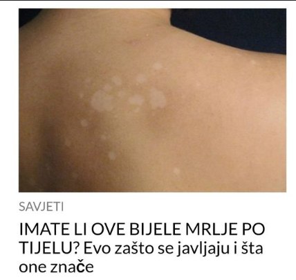 IMATE LI OVE BIJELE MRLJE PO TIJELU Evo zašto se javljaju i šta one znače Ukusno